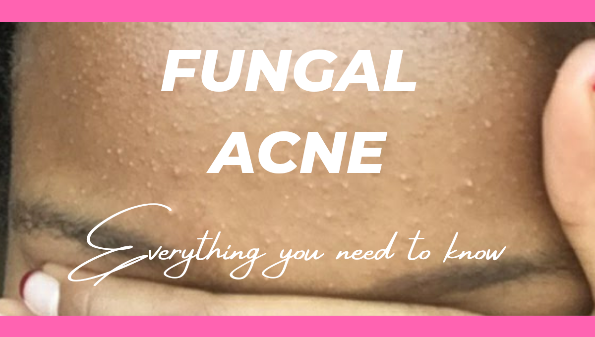HOW TO GET RID OF FUNGAL ACNE - Sharon Malonza